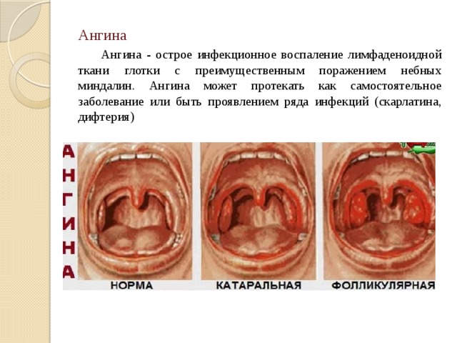 Ангина   Ангина - острое инфекционное воспаление лимфаденоидной ткани глотки с преимущественным поражением небных миндалин. Ангина может протекать как самостоятельное заболевание или быть проявлением ряда инфекций (скарлатина, дифтерия) 