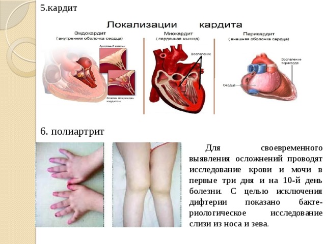 5.кардит   6. полиартрит  Для своевременного выявления осложнений проводят исследование крови и мочи в первые три дня и на 10-й день болезни. С целью исключения дифтерии показано бакте- риологическое исследование слизи из носа и зева. 