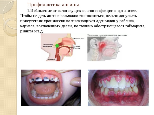  Профилактика ангины   1.Избавление от вялотекущих очагов инфекции в организме. Чтобы не дать ангине возможности появиться, нельзя допускать присутствия хронически воспаляющихся аденоидов у ребенка, кариеса, воспаленных десен, постоянно обостряющегося гайморита, ринита и т.д.       