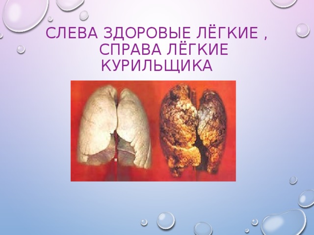 Слева здоровые лёгкие ,  справа лёгкие курильщика 
