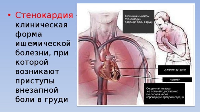 Актуальность стенокардии. Актуальность стенокардии курсовая. Стенокардия актуальность проблемы.