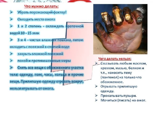 Ожоги Виды ожогов: в зависимости от повреждающего фактора разделяют на термические (горячей жидкостью, пламенем, раскаленным металлом), электрические и химические . По глубине поражения выделяют 4 степени. Площадь ожогов ориентировочно определяется с помощью правила девяток и правила ладоней. Площадь ладони взрослого человека составляет около1 % площади тела. По правилу девяток крупные части тела составляют 9 или 18 % площади поверхности тела. Например, поверхность головы и шеи, поверхность руки составляют по 9 %, поверхность ноги, передняя поверхность туловища - по 18 %. Ожоги считаются тяжелыми, если общая поверхность повреждений составляет более 10 %. 