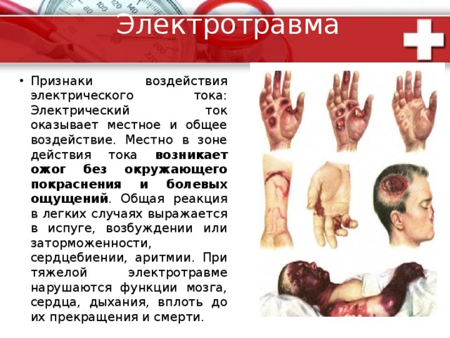 Помощь при отморожении :  Надо согреть отмороженную область. Конкретные способы зависят от обстановки. Пострадавшего доставьте в помещение. Если у Вас есть возможность, то отогрейте отмороженную область в ванне с водой, температуру которой постепенно повышайте от 36 до 40 °С в течение 15 мин. Одновременно массируйте конечность от периферии к центру. Через 30 мин кожу насухо вытрите и обработайте спиртом, наложите сухие стерильные повязки с толстым слоем ваты снаружи. При отморожении лица и ушных раковин разотрите их чистой рукой или мягкой тканью до порозовения, обработайте спиртом и вазелиновым маслом. Нельзя для растирания пользоваться снегом. Он вызовет повреждение поверхностного слоя кожи. Необходимо согреть пациента, напоив его горячим чаем и укутав одеялом. Если отморожение сопровождается появлением пузырей и некрозом, обязательно госпитализируйте пациента. 