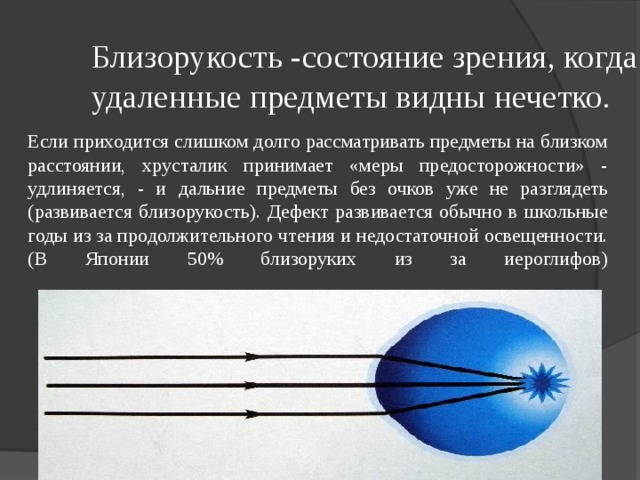 Один глаз видит размыто на любом расстоянии