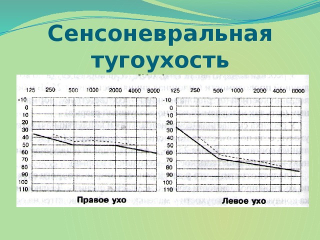 Сенсоневральная тугоухость картинки