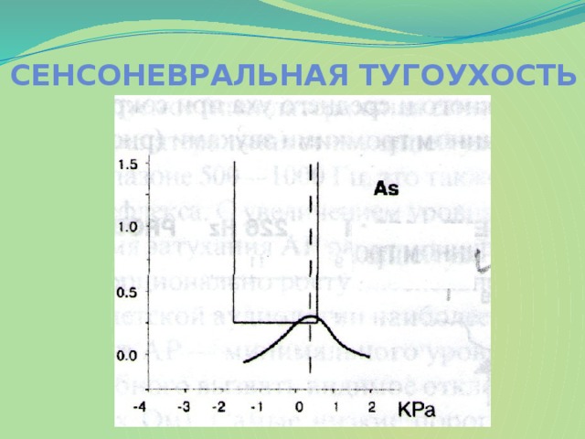 Сенсоневральная тугоухость презентация
