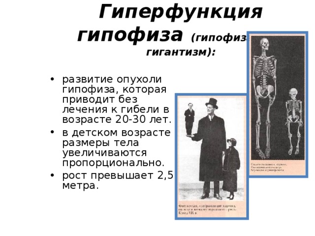 Карликовость гигантизм акромегалия. Гипофиз гипофункция и гиперфункция. Гиперфункция гипофиза соматотропного гормона. Проявление гипо и гиперфункции гипофиза. Гиперфункция гормона роста.