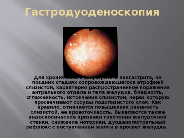 Гастродуоденоскопия Для хронического диффузного пангастрита, на поздних стадиях сопровождающегося атрофией слизистой, характерно распространенное поражение антрального отдела и тела желудка, бледность, сглаженность, истончение слизистой, через которую просвечивают сосуды подслизистого слоя. Как правило, отмечается повышенная ранимость слизистой, ее кровоточивость. Выявляются также эндоскопические признаки гипотонии желудочной стенки, снижение моторики, дуоденогастральный рефлюкс с поступлением желчи в просвет желудка. 