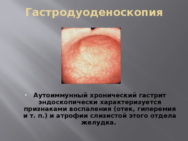 Гастродуоденоскопия Аутоиммунный хронический гастрит эндоскопически характеризуется признаками воспаления (отек, гиперемия и т. п.) и атрофии слизистой этого отдела желудка.  
