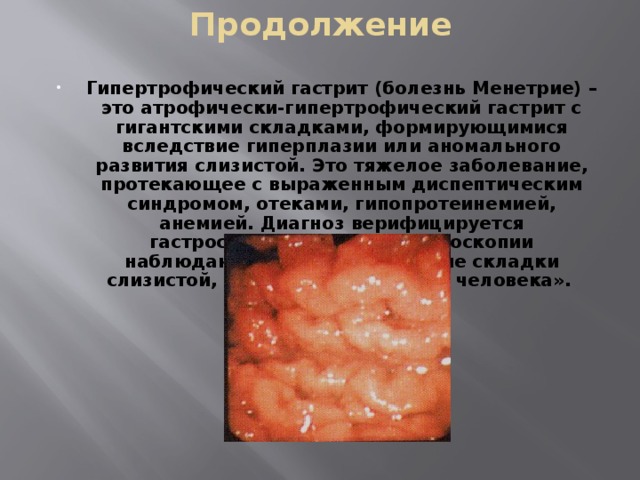 Продолжение Гипертрофический гастрит (болезнь Менетрие) – это атрофически-гипертрофический гастрит с гигантскими складками, формирующимися вследствие гиперплазии или аномального развития слизистой. Это тяжелое заболевание, протекающее с выраженным диспептическим синдромом, отеками, гипопротеинемией, анемией. Диагноз верифицируется гастроскопически. При гастроскопии наблюдаются широкие, высокие складки слизистой, напоминающие «мозг человека».  