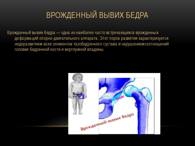 Врожденные вывихи бедра презентация