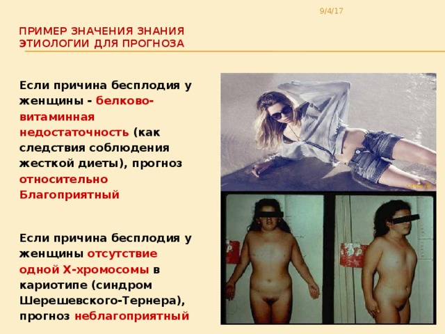 9/4/17 Пример значения знания  этиологии для прогноза   Если причина бесплодия у женщины - белково- витаминная недостаточность (как следствия соблюдения жесткой диеты), прогноз относительно Благоприятный   Если причина бесплодия у женщины отсутствие одной Х-хромосомы в кариотипе (синдром Шерешевского-Тернера), прогноз неблагоприятный  