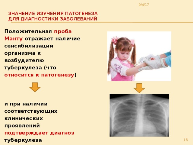 9/4/17 Значение изучения патогенеза  для диагностики заболеваний   Положительная проба Манту отражает наличие сенсибилизации организма к возбудителю туберкулеза (что относится к патогенезу )    и при наличии соответствующих клинических проявлений подтверждает диагноз туберкулеза  