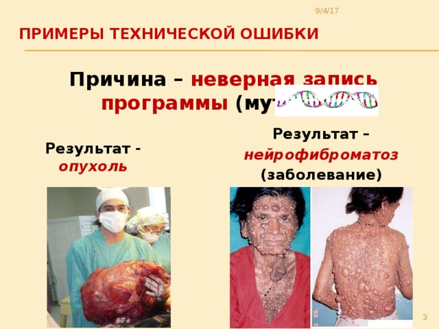 9/4/17 Примеры технической ошибки   Причина – неверная запись программы (мутация) Результат – нейрофиброматоз (заболевание) Результат - опухоль  