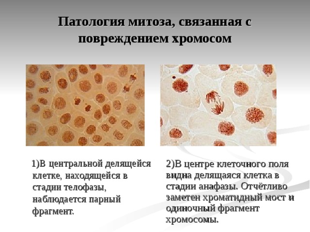 Патология митоза, связанная с повреждением хромосом 2)В центре клеточного поля видна делящаяся клетка в стадии анафазы. Отчётливо заметен хроматидный мост и одиночный фрагмент хромосомы.  1)В центральной делящейся клетке, находящейся в стадии телофазы, наблюдается парный фрагмент. 