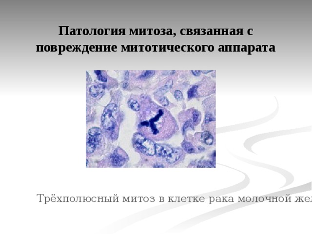 Патология митоза, связанная с повреждение митотического аппарата Трёхполюсный митоз в клетке рака молочной железы  