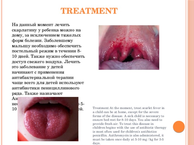 Treatment На данный момент лечить скарлатину у ребенка можно на дому, за исключением тяжелых форм болезни. Заболевшему малышу необходимо обеспечить постельный режим в течении 8-10 дней. Также нужно обеспечить доступ свежего воздуха. Лечить это заболевание у детей начинают с применения антибактериальной терапии чаще всего для детей используют антибиотики пенициллинового ряда. Также назначают Азитромицин, принимать его необходимо один раз в сутки по 5-10 мг/кг на протяжении 3-5 дней. Treatment At the moment, treat scarlet fever in a child can be at home, except for the severe forms of the disease. A sick child is necessary to ensure bed rest for 8-10 days. You also need to provide fresh air. To treat this disease in children begins with the use of antibiotic therapy is most often used for children's antibiotics penicillin. Azithromycin is also administered, it must be taken once daily at 5-10 mg / kg for 3-5 days. 