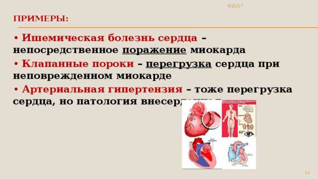 9/21/17 Примеры:   • Ишемическая болезнь сердца – непосредственное поражение миокарда • Клапанные пороки – перегрузка сердца при неповрежденном миокарде • Артериальная гипертензия – тоже перегрузка сердца, но патология внесердечная 5 