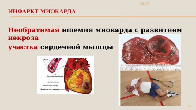 9/21/17 Инфаркт миокарда   Необратимая ишемия миокарда с развитием некроза участка сердечной мышцы  