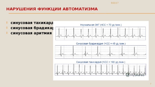 Брадикардия карта вызова