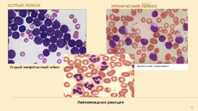 Хронический лейкоз картина крови