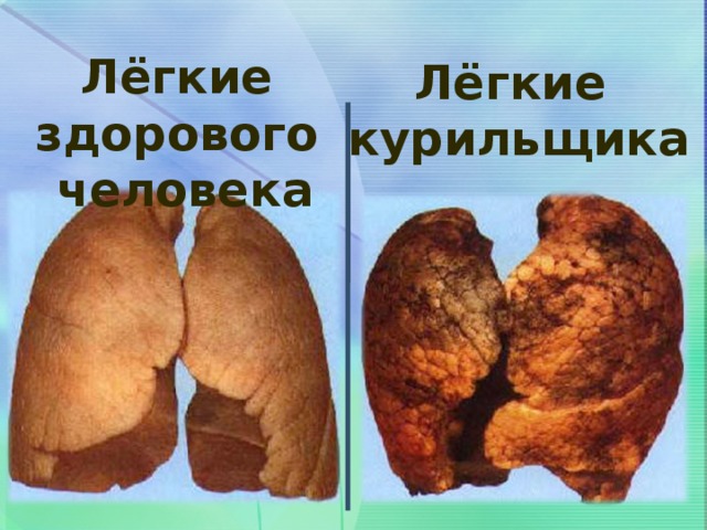 Лёгкие здорового  человека Лёгкие курильщика 
