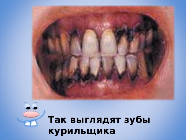 Так выглядят зубы курильщика 