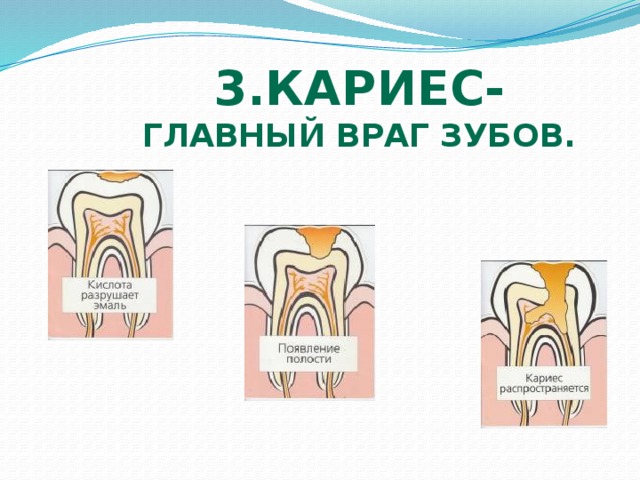 3.Кариес- главный враг зубов. 