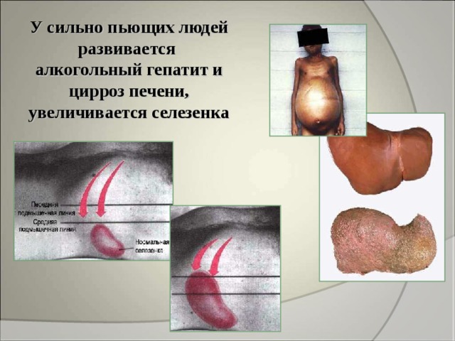 У сильно пьющих людей развивается алкогольный гепатит и цирроз печени, увеличивается селезенка 
