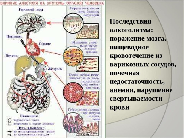 Последствия алкоголизма:  поражение мозга, пищеводное кровотечение из варикозных сосудов, почечная недостаточность, анемия, нарушение свертываемости крови 