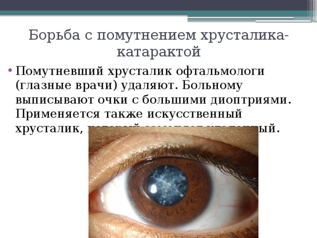 Борьба с помутнением хрусталика- катарактой Помутневший хрусталик офтальмологи (глазные врачи) удаляют. Больному выписывают очки с большими диоптриями. Применяется также искусственный хрусталик, который заменяет удаленный. 
