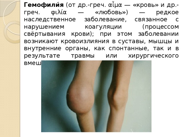 Гемофили́я (от др.-греч. αἷμα — «кровь» и др.-греч. φιλία — «любовь») — редкое наследственное заболевание, связанное с нарушением коагуляции (процессом свёртывания крови); при этом заболевании возникают кровоизлияния в суставы, мышцы и внутренние органы, как спонтанные, так и в результате травмы или хирургического вмешательства. 