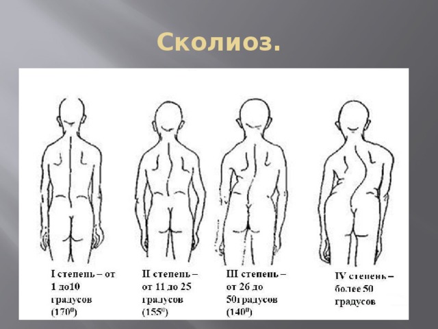 Проект 9 класс сколиоз Заболевание опорно-двигательного аппарата у детей 8-16 лет.