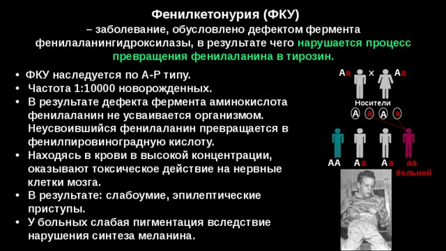 Фенилкетонурия (ФКУ) – заболевание, обусловлено дефектом фермента фенилаланингидроксилазы, в результате чего нарушается процесс превращения фенилаланина в тирозин.   А а   Х  А а ФКУ наследуется по А-Р типу. Частота 1:10000 новорожденных. В результате дефекта фермента аминокислота фенилаланин не усваивается организмом. Неусвоившийся фенилаланин превращается в  фенилпировиноградную кислоту. Находясь в крови в высокой концентрации,  оказывают токсическое действие на нервные  клетки мозга. В результате: слабоумие, эпилептические приступы. У больных слабая пигментация вследствие нарушения синтеза меланина. Носители а А а  А  АА А а  А а  аа больной 