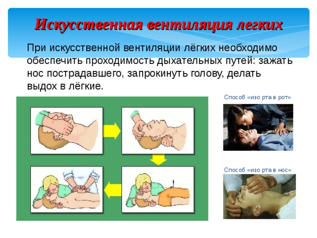 Искусственная вентиляция