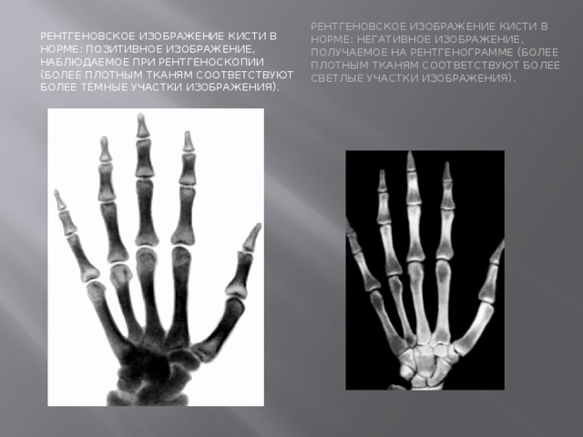Отличается рентген. Позитивное рентгеновское изображение. Позитивное изображение рентген. Рентген кисти позитивное изображение. Негативное и позитивное рентгеновское изображение.