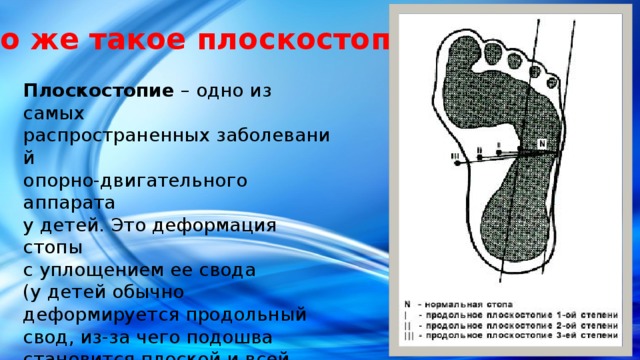 Что же такое плоскостопие? Плоскостопие  – одно из самых распространенных заболеваний  опорно-двигательного аппарата у детей. Это деформация стопы с уплощением ее свода (у детей обычно деформируется продольный свод, из-за чего подошва становится плоской и всей своей поверхностью касается пола). 