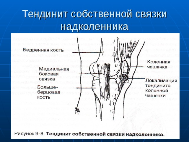 Связка надколенника. Оссификация связки надколенника. Тендинит сухожилия надколенника. Тендинопатия связки надколенника. Оссифицирующий тендинит собственной связки надколенника.