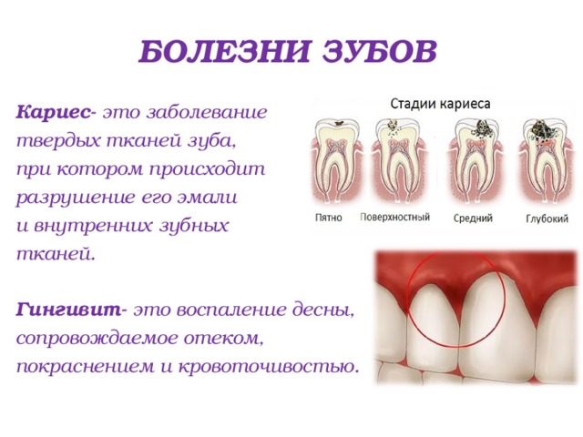 Заболевания зубов и полости. Бывает ли кариес сбоку зуба. Пришеечный кариес фронтальных зубов. Таблица поражением кариесов зубов. Распространенные болезни зубов.