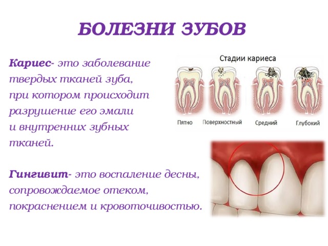 Стадии бывают. Болезни зубов пародонтит кариес. Профилактика заболеваний зубов таблица. Кариозное поражение зуба. Заболевания зубов кратко.