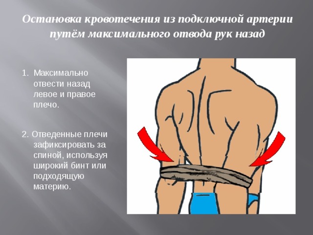 Остановка кровотечения из подключной артерии путём максимального отвода рук назад Максимально отвести назад левое и правое плечо. 2. Отведенные плечи зафиксировать за спиной, используя широкий бинт или подходящую материю. 