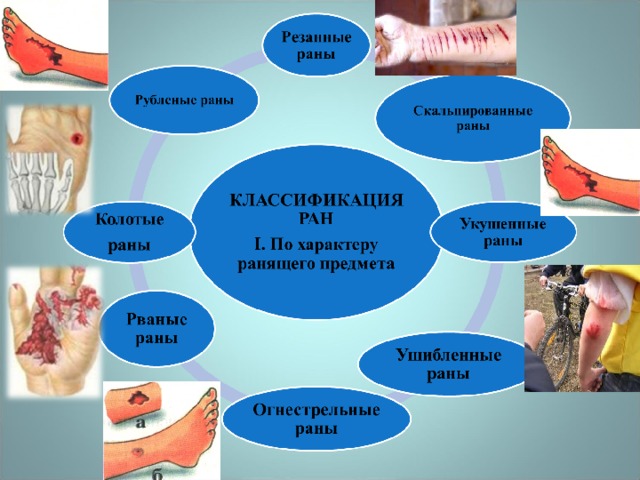 Причины ран. Раны понятие классификация характеристика первая помощь. Раны классификация РАН И их характеристика.