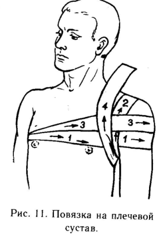 Повязка на плечо бинтом