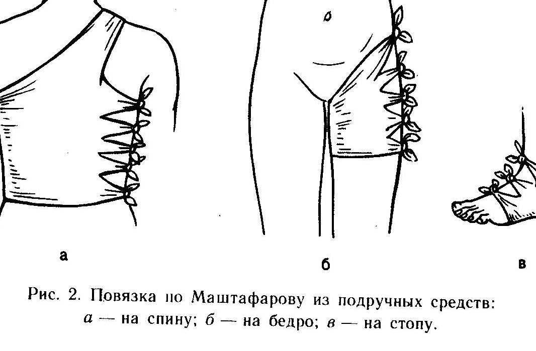 Посмотрите на рисунок 1 и подпишите типы бинтовых повязок