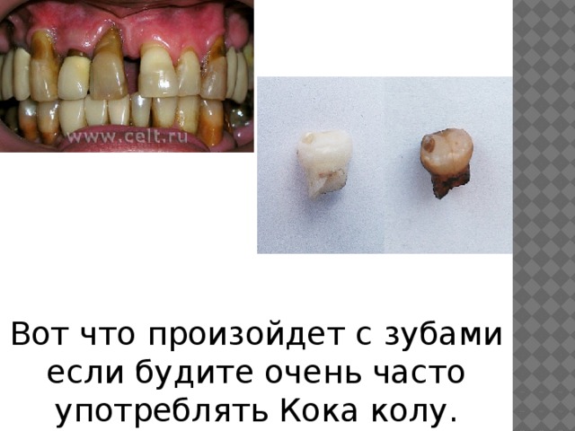 Вот что произойдет с зубами если будите очень часто употреблять Кока колу. 