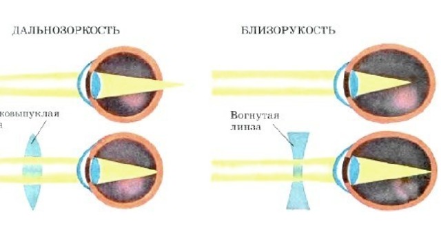 Рассмотрите рисунок сравните близорукость и дальнозоркость