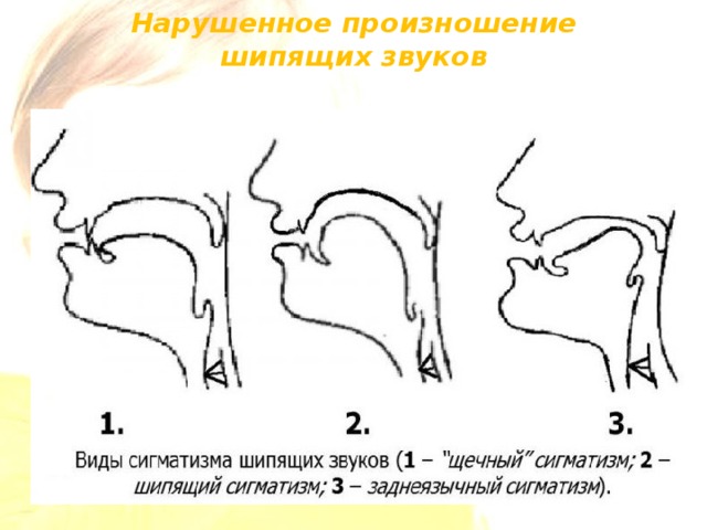 Нарушено произношение звуков. Губно-зубной сигматизм шипящих звуков. Боковой сигматизм свистящих профиль. Сигматизм это в логопедии. Боковой сигматизм шипящих звуков.