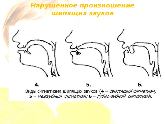 Схема взаимосвязи звуков при ринолалии