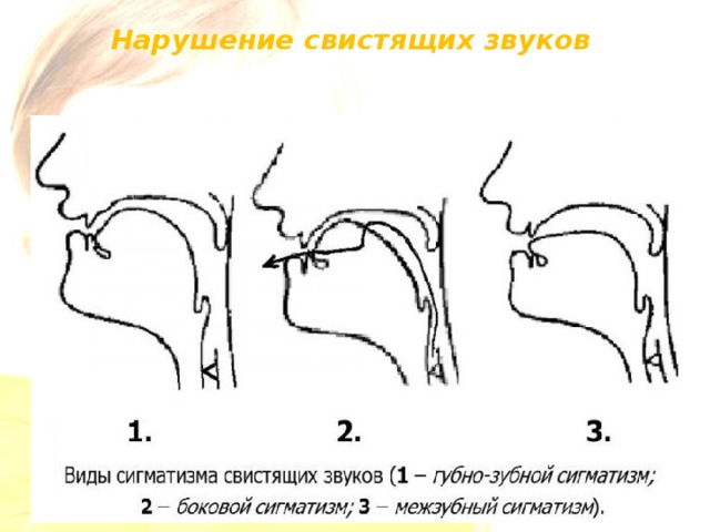 Схема взаимосвязи звуков при ринолалии