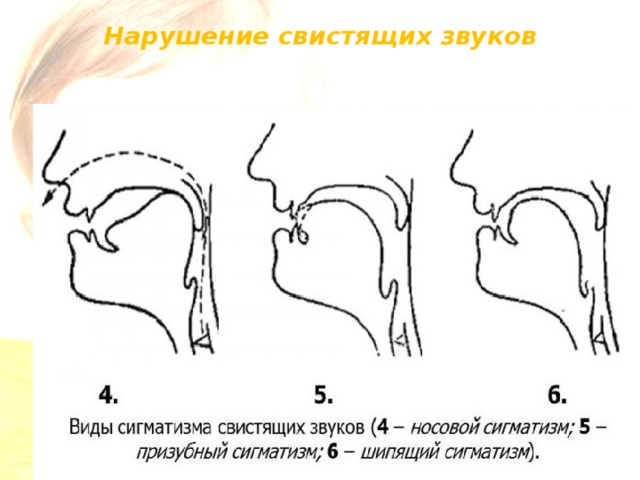 Расстройство артикуляции. Артикуляции свистящих звуков при ринолалии. Профили артикуляции свистящих звуков при ринолалии. Артикуляционный профиль звуков при ринолалии. Межзубный сигматизм профиль.